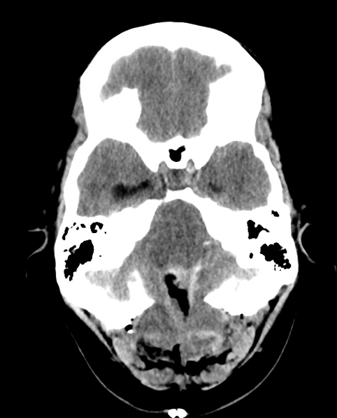 File:Cerebellar ependymoma complicated by post-operative subdural hematoma (Radiopaedia 83322-97737 Axial non-contrast 23).png
