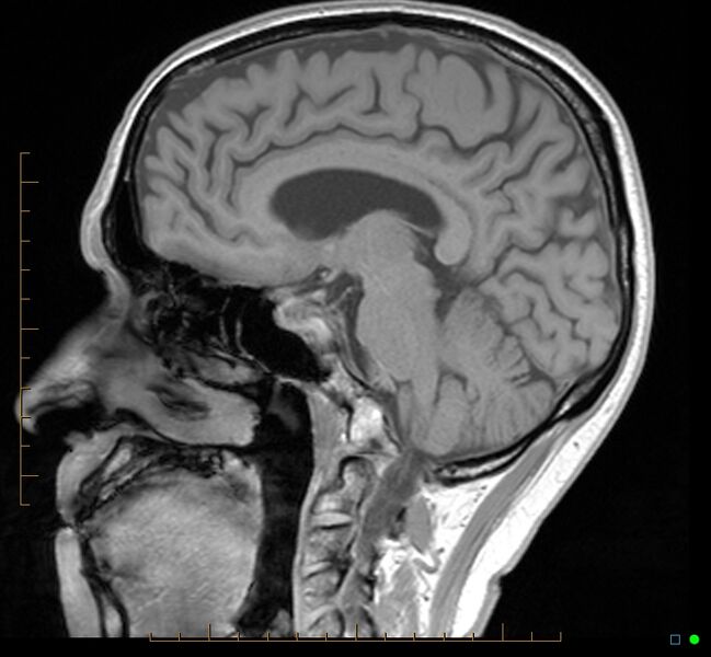 File:Cerebellar gangliocytoma (Radiopaedia 65377-74422 Sagittal T1 24).jpg
