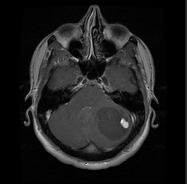 File:Cerebellar hemangioblastoma (Radiopaedia 11472-11835 Axial 3).jpg
