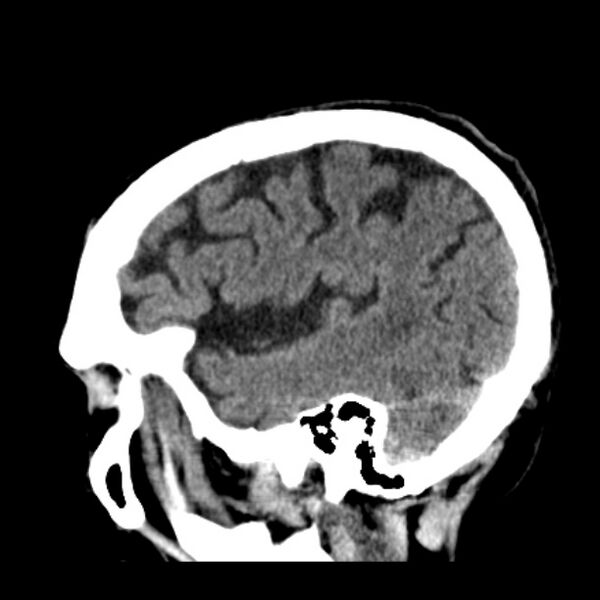 File:Cerebellar hemorrhage (Radiopaedia 27193-27359 C 36).jpg