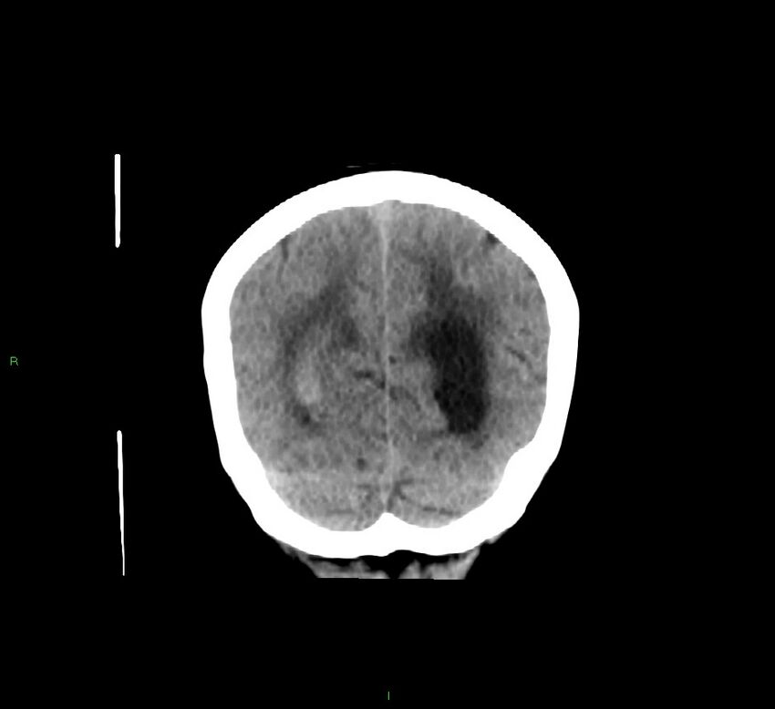 Cerebellar hemorrhage (Radiopaedia 58793-66027 Coronal non-contrast 18).jpg