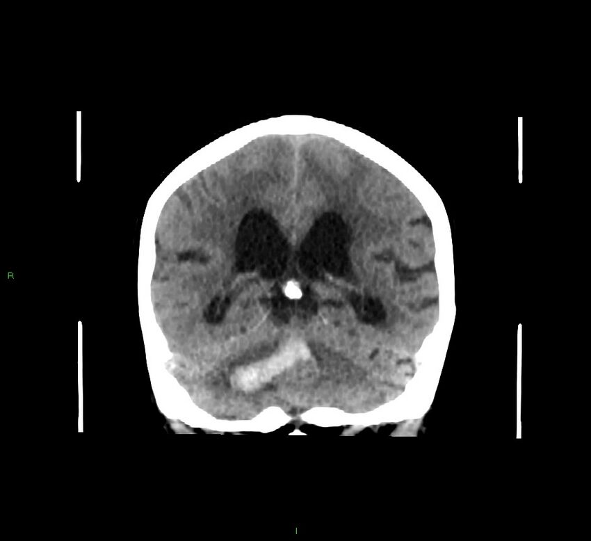 Cerebellar hemorrhage (Radiopaedia 58793-66027 Coronal non-contrast 28).jpg
