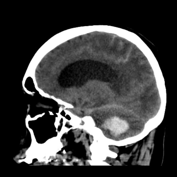 File:Cerebellar hemorrhage causing obstructive hydrocephalus (Radiopaedia 33989-35207 B 20).jpg