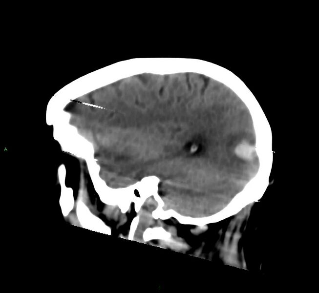 File:Cerebral amyloid angiopathy-associated lobar intracerebral hemorrhage (Radiopaedia 58377-65514 B 14).jpg