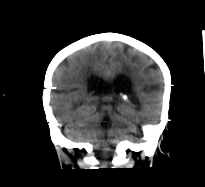 File:Cerebral amyloid angiopathy-associated lobar intracerebral hemorrhage (Radiopaedia 58377-65514 Coronal non-contrast 26).jpg