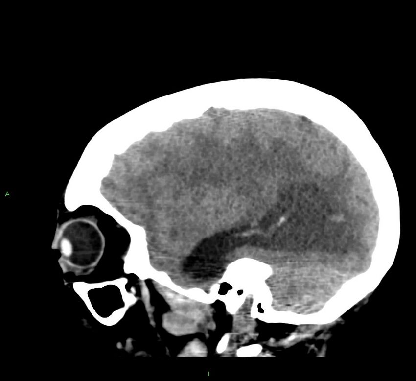 Cerebral amyloid angiopathy-associated lobar intracerebral hemorrhage (Radiopaedia 58379-65519 C 39).jpg