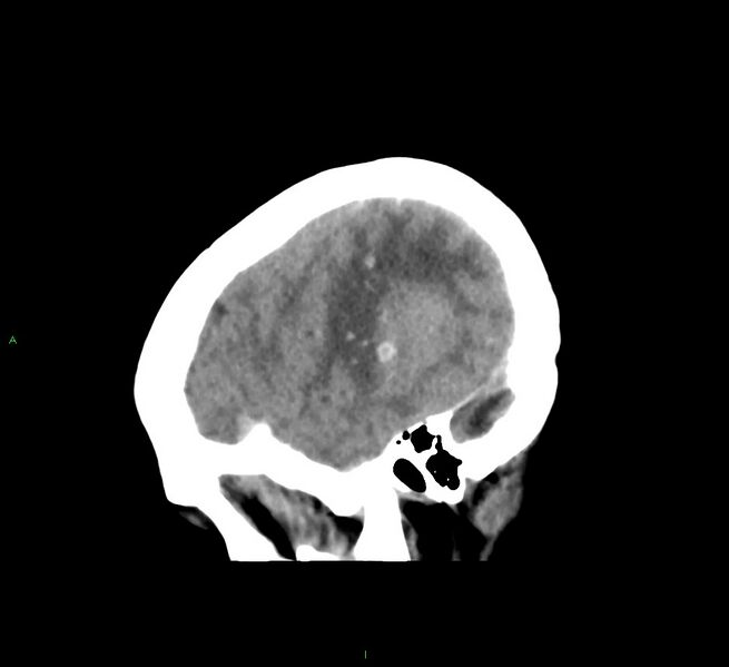 File:Cerebral amyloid angiopathy-associated lobar intracerebral hemorrhage (Radiopaedia 58563-65727 C 12).jpg