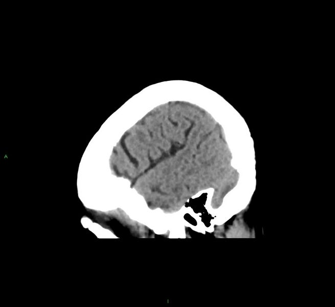 File:Cerebral amyloid angiopathy-associated lobar intracerebral hemorrhage (Radiopaedia 58563-65727 C 44).jpg