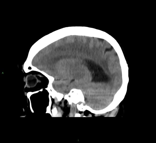 File:Cerebral amyloid angiopathy-associated lobar intracerebral hemorrhage (Radiopaedia 58751-65972 C 37).jpg