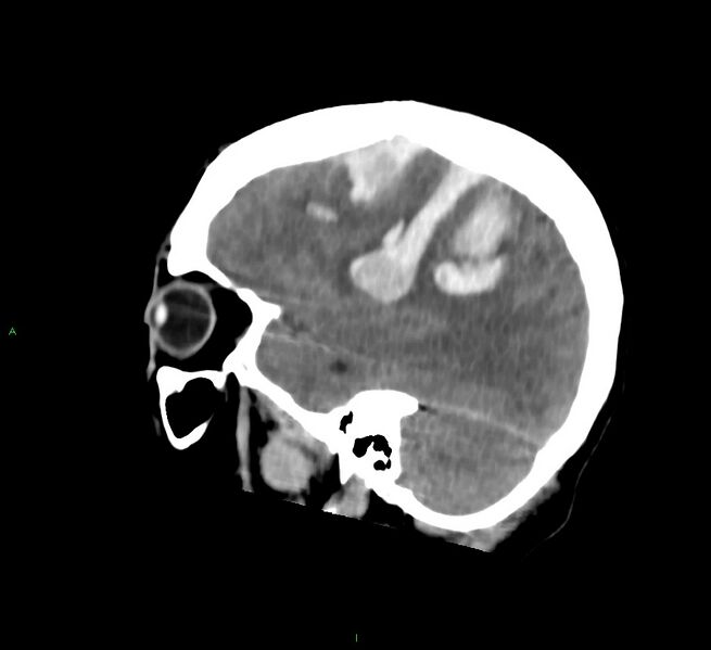 File:Cerebral amyloid angiopathy-associated lobar intracerebral hemorrhage (Radiopaedia 58756-65977 C 18).jpg