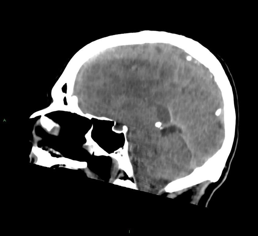 Cerebral amyloid angiopathy-associated lobar intracerebral hemorrhage (Radiopaedia 58756-65977 C 30).jpg