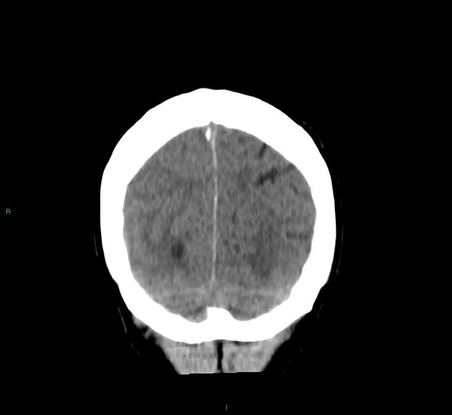 File:Cerebral amyloid angiopathy-associated lobar intracerebral hemorrhage (Radiopaedia 58756-65977 Coronal non-contrast 14).jpg