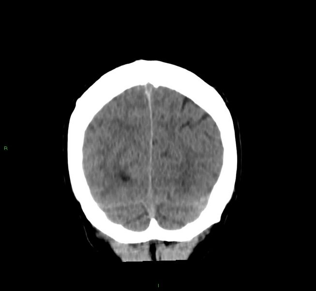 File:Cerebral amyloid angiopathy-associated lobar intracerebral hemorrhage (Radiopaedia 58756-65977 Coronal non-contrast 15).jpg