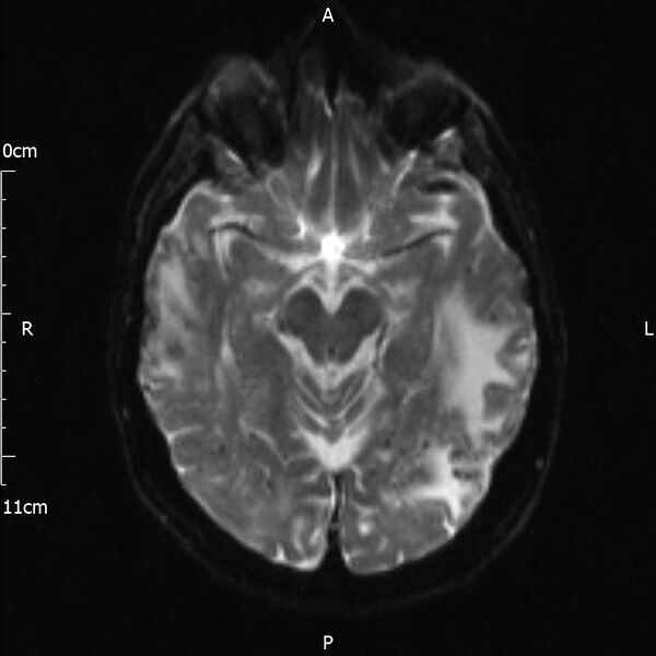 File:Cerebral amyloid angiopathy related inflammation (Radiopaedia 72772-83415 Axial DWI 10).jpg