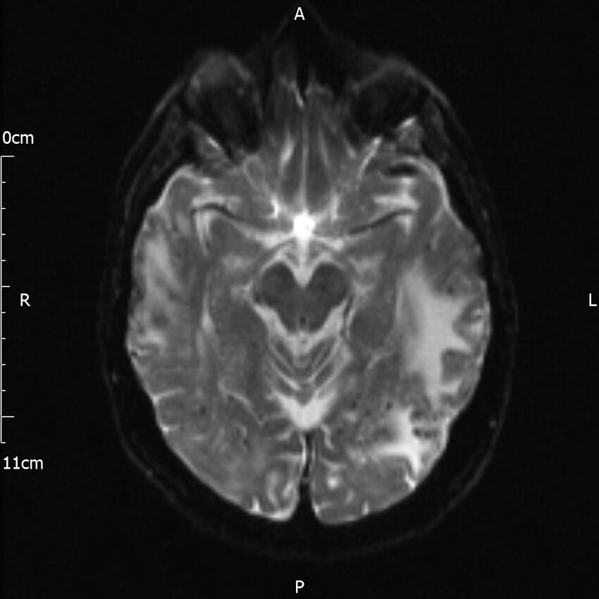 Cerebral amyloid angiopathy related inflammation (Radiopaedia 72772-83415 Axial DWI 10).jpg