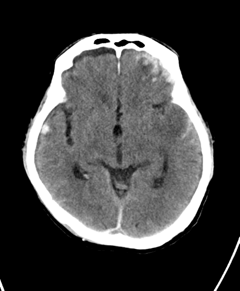 File:Cerebral contusions, subarachnoid hemorrhage and subdural hygromas (Radiopaedia 55399-61828 Axial non-contrast 13).png