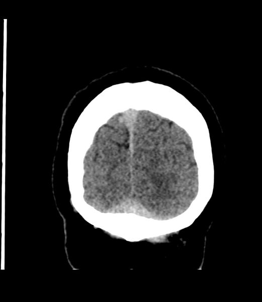 File:Cerebral dural venous sinus thrombosis (Radiopaedia 86514-102575 Coronal non-contrast 50).jpg