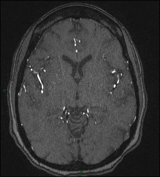 File:Cerebral fat embolism (Radiopaedia 35022-36525 Axial TOF 100).jpg