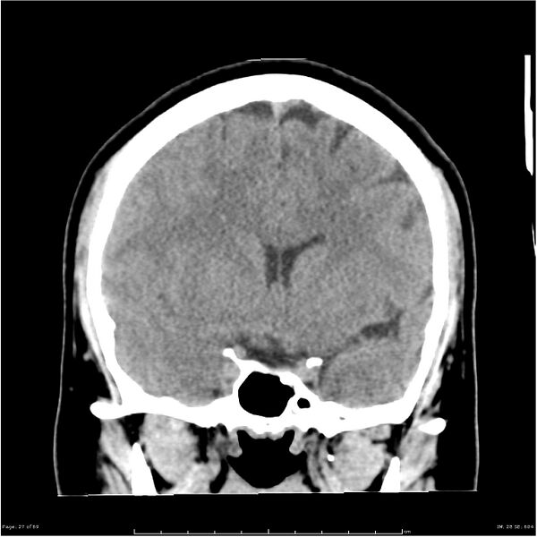 File:Cerebral hemorrhage secondary to arteriovenous malformation (Radiopaedia 33497-34561 Coronal non-contrast 18).jpg