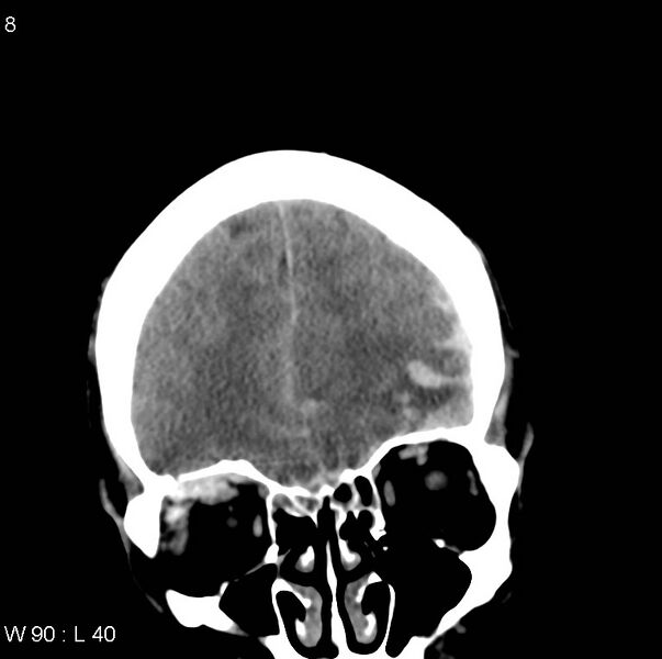 File:Cerebral hemorrhagic contusion with subdural and subarachnoid hemorrhage (Radiopaedia 10680-11146 Coronal non-contrast 4).jpg
