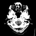 Cerebral hemorrhagic contusions (Radiopaedia 23145-23188 Axial non-contrast 4).jpg
