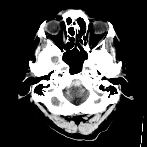 File:Cerebral hemorrhagic contusions (Radiopaedia 23145-23188 Axial non-contrast 4).jpg