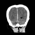 Cerebral hemorrhagic contusions (Radiopaedia 23145-23188 Coronal non-contrast 37).jpg