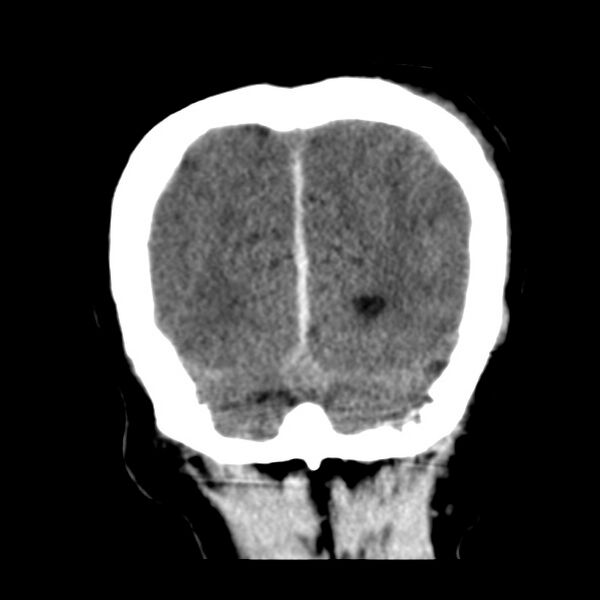 File:Cerebral hemorrhagic contusions (Radiopaedia 23145-23188 Coronal non-contrast 37).jpg