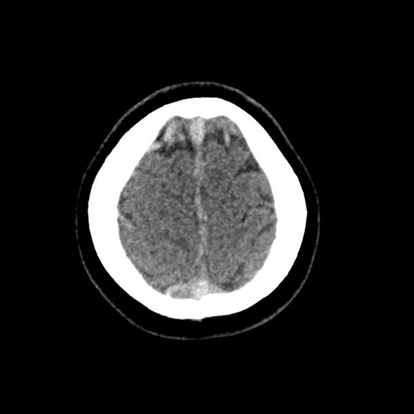 File:Cerebral venous sinus thrombosis (Radiopaedia 59224-66551 Axial non-contrast 49).jpg