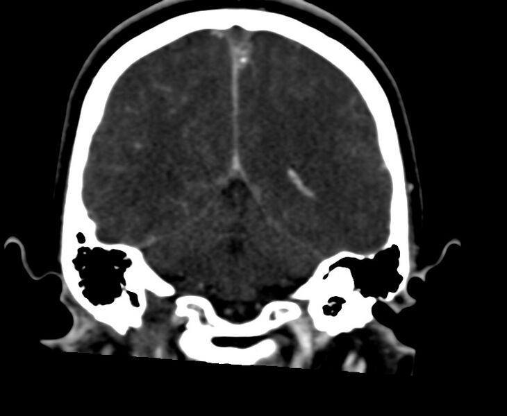 File:Cerebral venous sinus thrombosis (Radiopaedia 59224-66646 Coronal C+ delayed 51).jpg