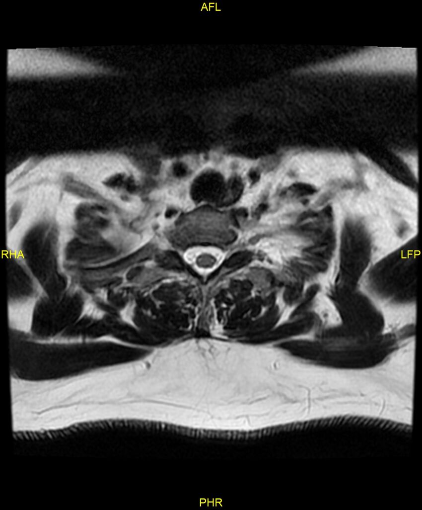 Cervical disc protrusion (Radiopaedia 87147-103415 Axial T2 81).jpg