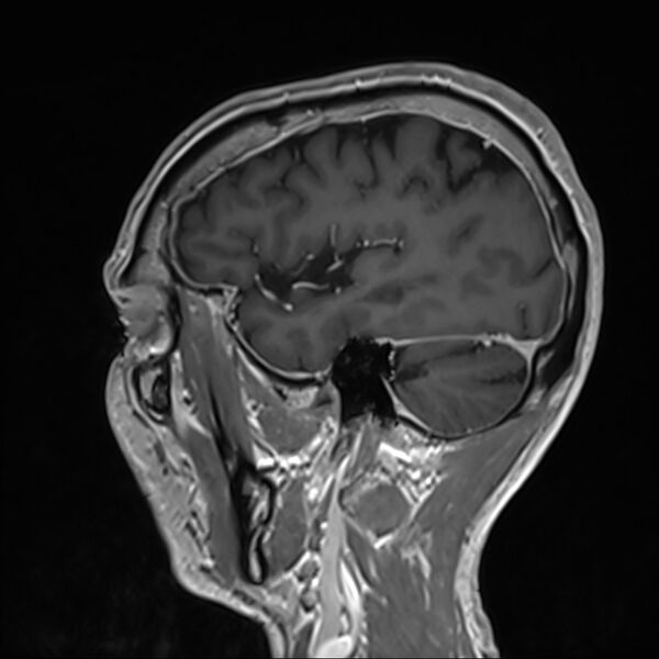 File:Cervical dural CSF leak on MRI and CT treated by blood patch (Radiopaedia 49748-54995 G 95).jpg