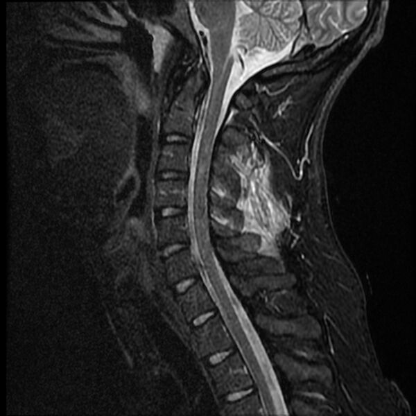 File:Cervical facet fracture and anterior discoligamentous injury (Radiopaedia 32139-33084 Sagittal STIR 9).jpg