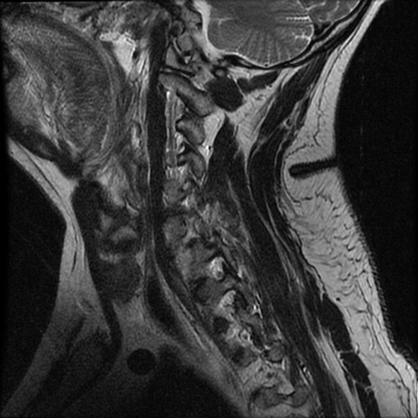 File:Cervical fracture and dislocation with locked facet (Radiopaedia 31837-32781 Sagittal T2 3).jpg