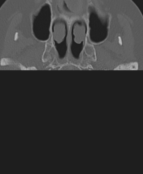 File:Cervical spine ACDF loosening (Radiopaedia 48998-54071 Axial bone window 2).png