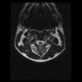 Cervical vertebrae metastasis (Radiopaedia 78814-91667 Axial T2 18).png