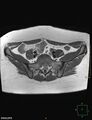 Cesarian scar endometriosis (Radiopaedia 68495-78066 Axial T1 2).jpg