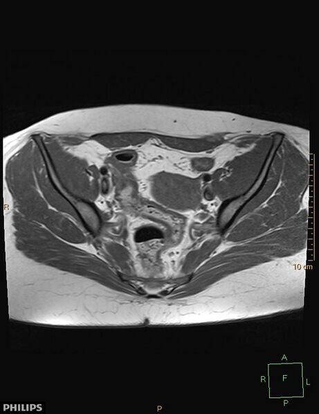 File:Cesarian scar endometriosis (Radiopaedia 68495-78066 Axial T1 9).jpg