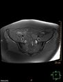 Cesarian scar endometriosis (Radiopaedia 68495-78066 Axial T1 fat sat 5).jpg