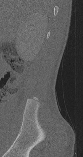 File:Chance fracture (Radiopaedia 40360-42912 Sagittal bone window 95).png