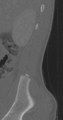 Chance fracture (Radiopaedia 40360-42912 Sagittal bone window 95).png