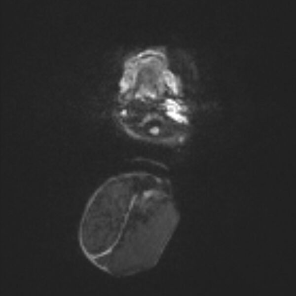 File:Chiari III malformation with occipital encephalocele (Radiopaedia 79446-92559 Axial DWI 26).jpg