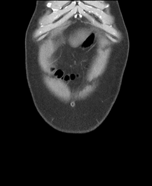 File:Cholecystitis with focal perforation and hepatic abscess (Radiopaedia 37189-38945 Coronal non-contrast 7).png