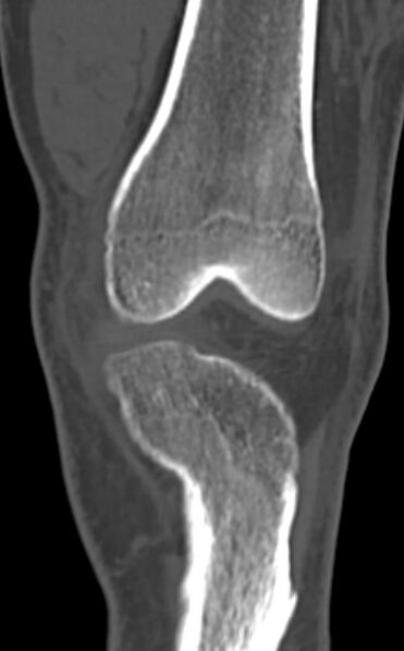 File:Chondrocalcinosis (Radiopaedia 82862-97173 Coronal bone window 26).jpg