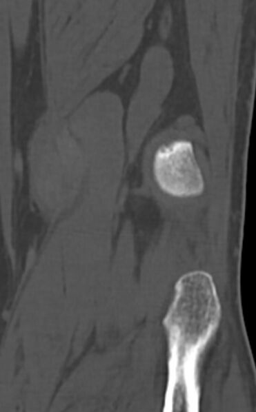 File:Chondrocalcinosis (Radiopaedia 82862-97173 Coronal bone window 68).jpg