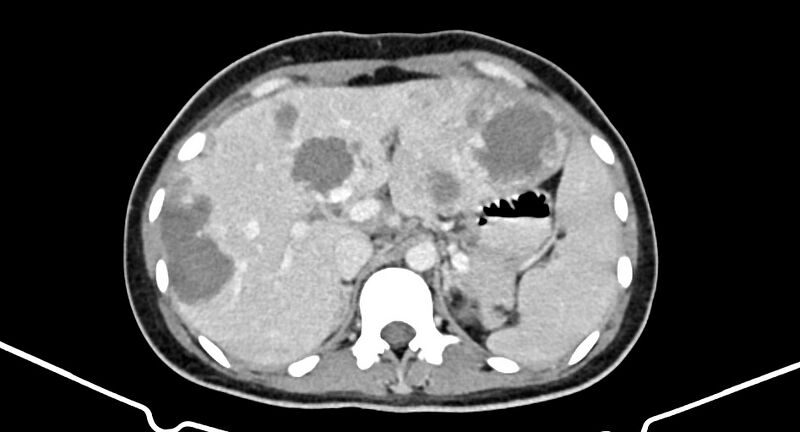 File:Choriocarcinoma liver metastases (Radiopaedia 74768-85766 A 65).jpg