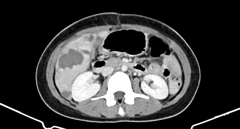 File:Choriocarcinoma liver metastases (Radiopaedia 74768-85766 A 99).jpg