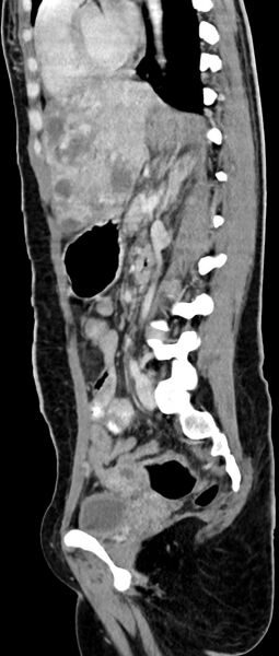 File:Choriocarcinoma liver metastases (Radiopaedia 74768-85766 C 86).jpg