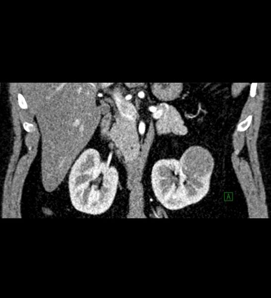 File:Chromophobe renal cell carcinoma (Radiopaedia 84286-99573 E 30).jpg