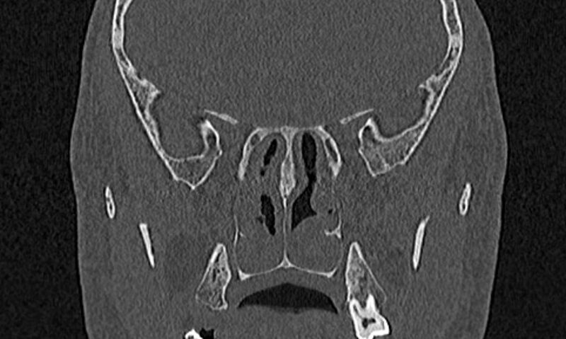 File:Chronic rhinosinusitis (Radiopaedia 65079-74075 Coronal bone window 59).jpg
